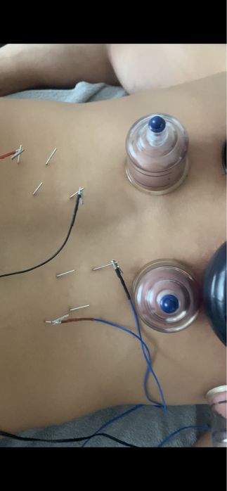 Recuperare Neurologică, Chiropractica,Acupunctură, Cupping( Ventuze)