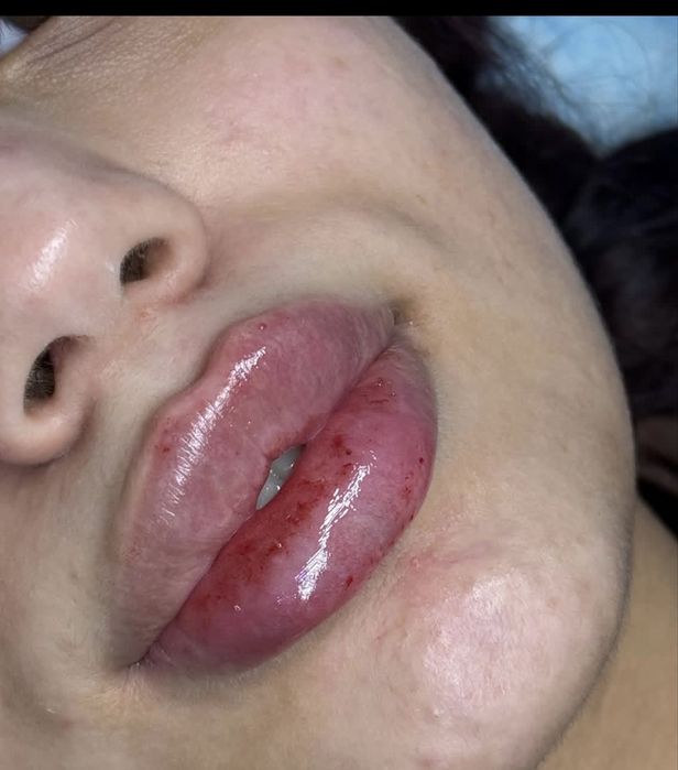 Увеличение губ,мезо,ботокс 30.000