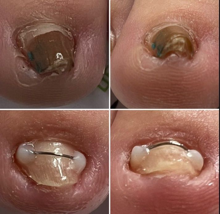 Подология лечение стоп и ногтей