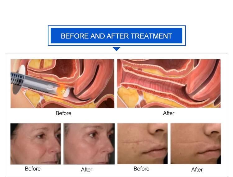 Со2 лазер оригинал  металический