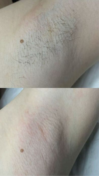 Услуги шугаринга с выездом