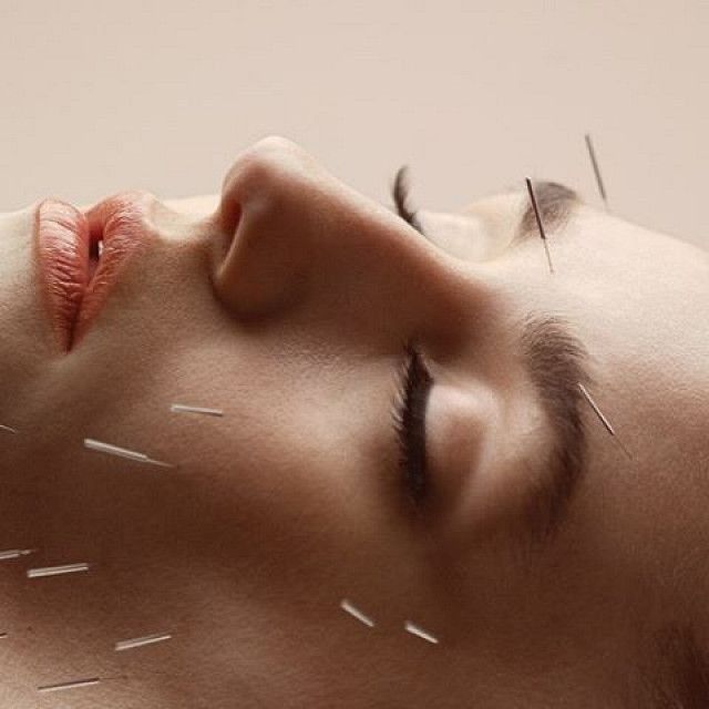 Алтын ине/иглотерапия/акупунктура