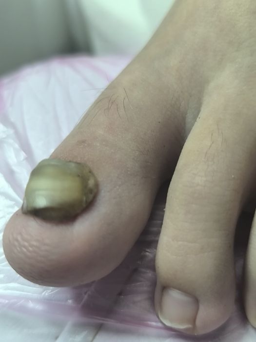 Медицински педикюр