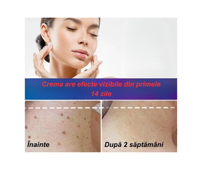 Crema pentru eliminarea papiloamelor