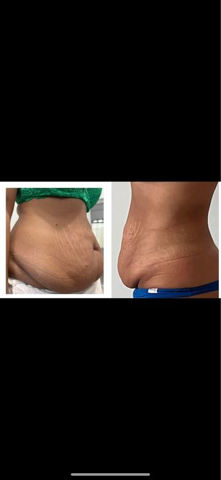 Lipoliză Injectabilă Fără Ac