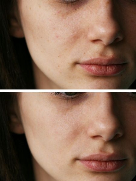 Чистка лица в Алматы