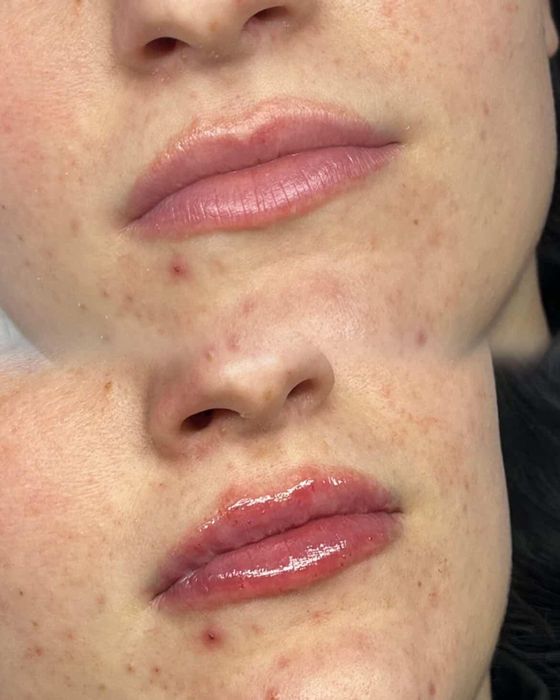 Volumizare buze -hyaluron pen