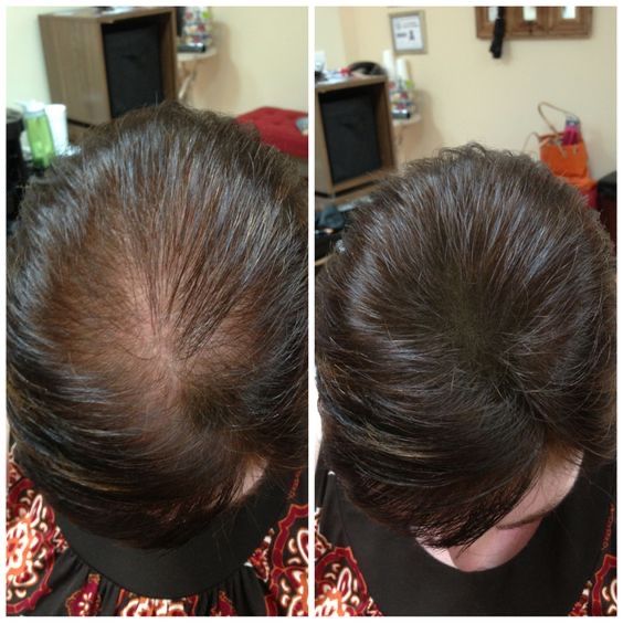 Soch tushishi yoki alopesiya bilan qiynalayapsizmi?Shifokor dermatolog