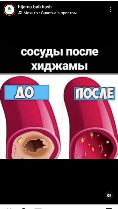 Хиджама профессионально. Банки есть!