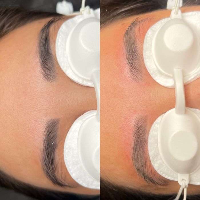 Удаление тату и татуаж