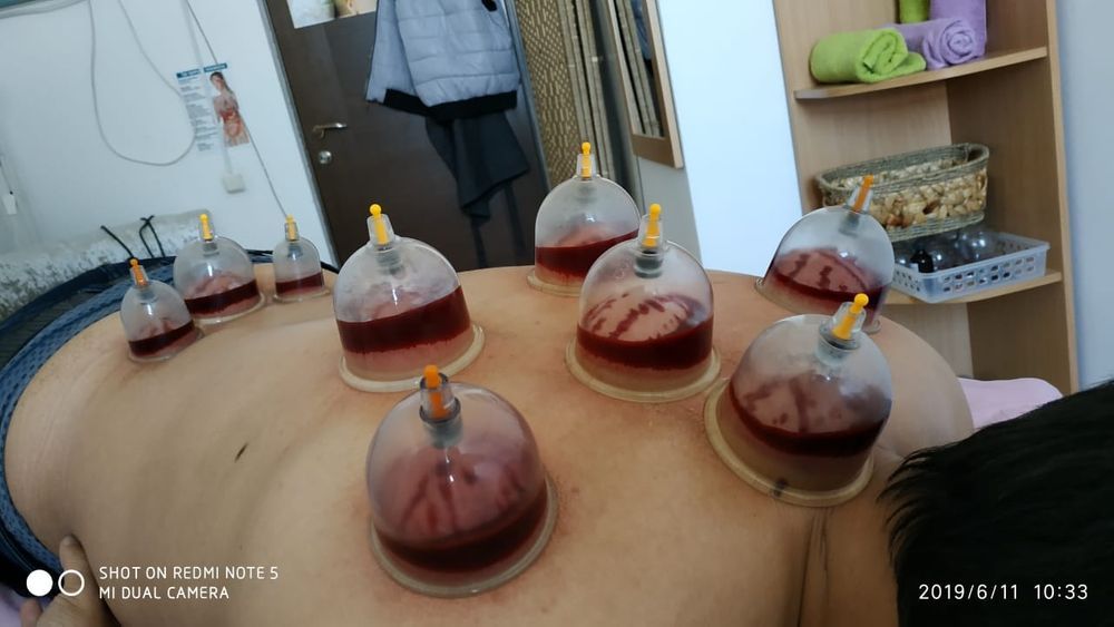 Хиджама профессионально