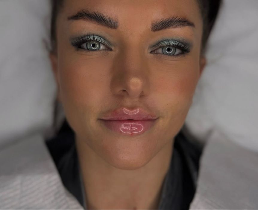 ADIO buze mici,urate,inestetice,volumizare buze cu hialuronic 1ml acid