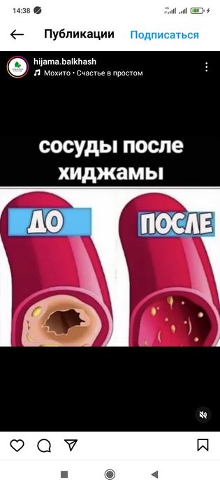 Хиджама ,массаж профессионально.Опыт 10 лет