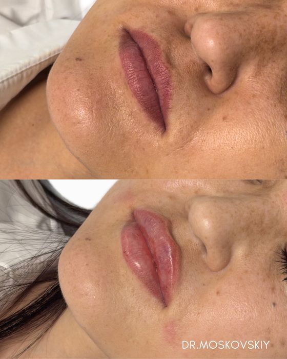 Увеличение губ|Алмата АКЦИЯ