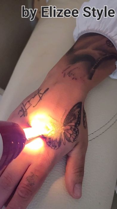 Stergere tatuaje cu fascicul laser tip picosecond