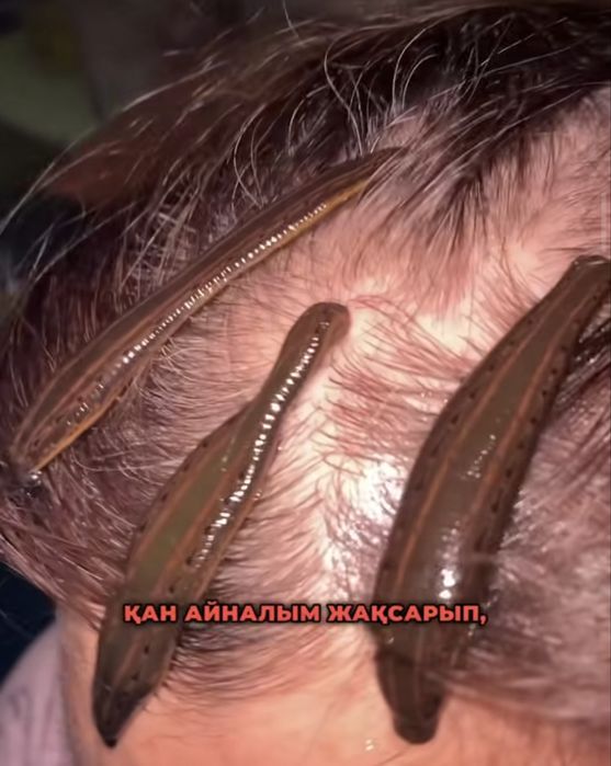 Лечения пиявками