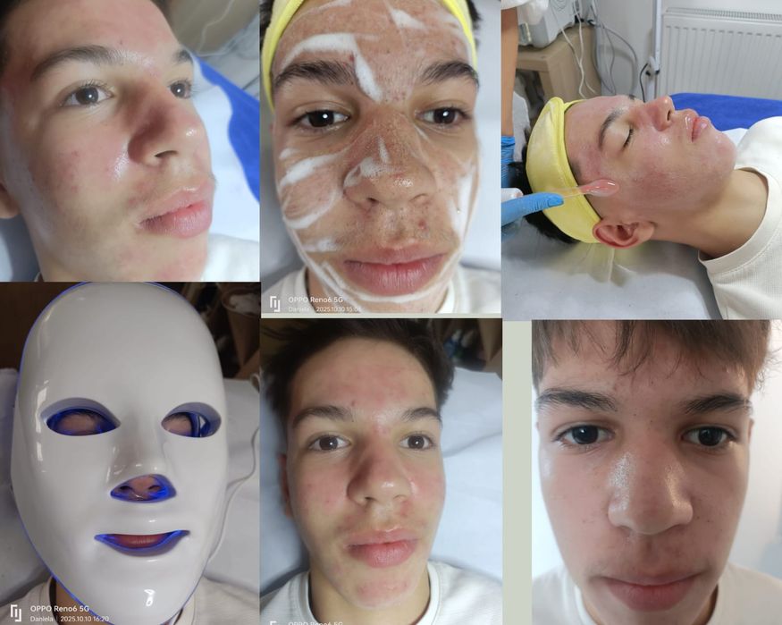 Tratamente faciale ,pensat și epilat cu ceara!