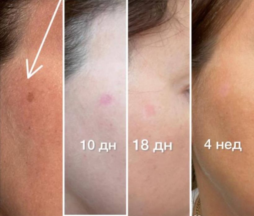 Expigment 4% крем — для отбеливания кожи окартирувчи крем