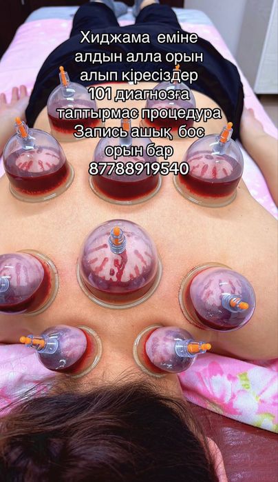 Хиджама, Пиявки Массаж емдері