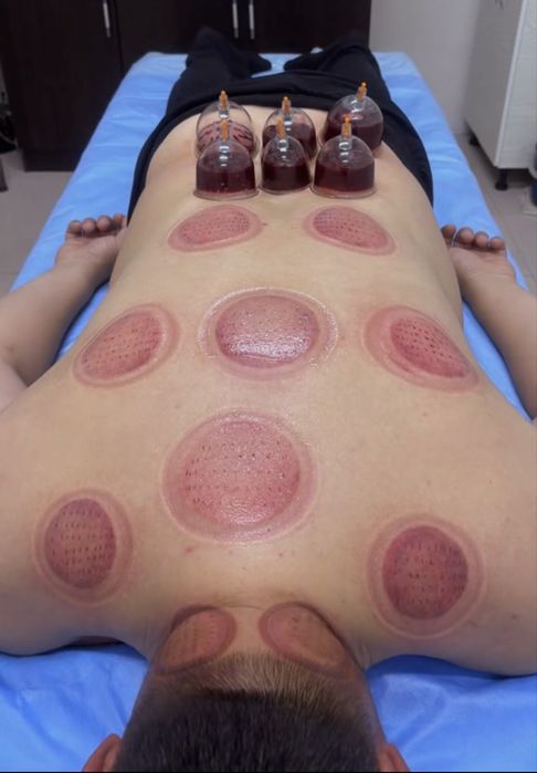 Хиджама, Пиявки Массаж емдері