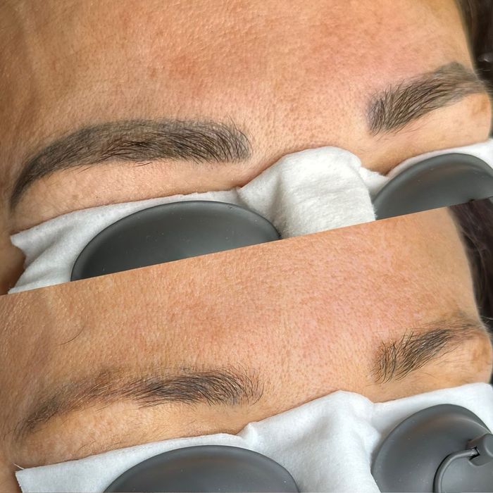 Удаление татуажа , тату