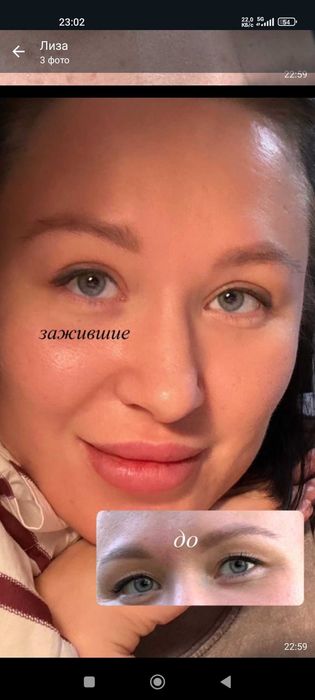 Блефаропластика.