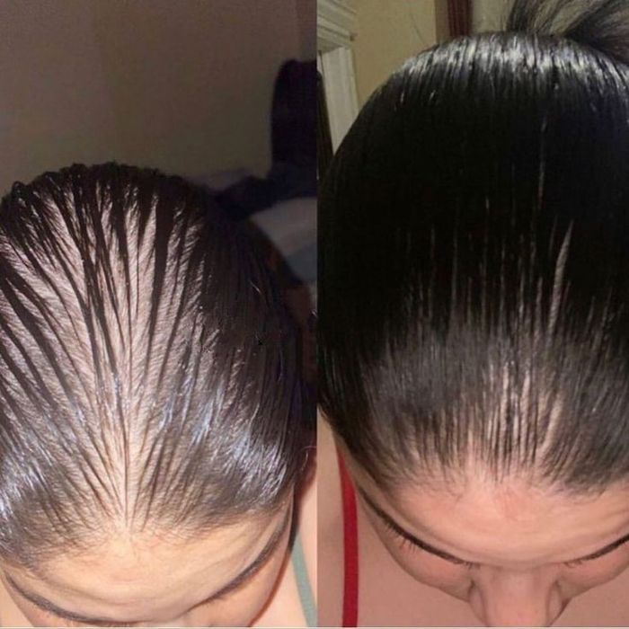 Soch tushishi yoki alopesiya bilan qiynalayapsizmi?Shifokor dermatolog