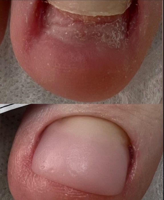 Подология лечение стоп и ногтей