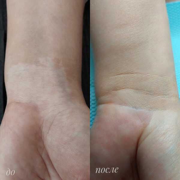 Vitiligo dog'larini kamuflyaj bilan yopish