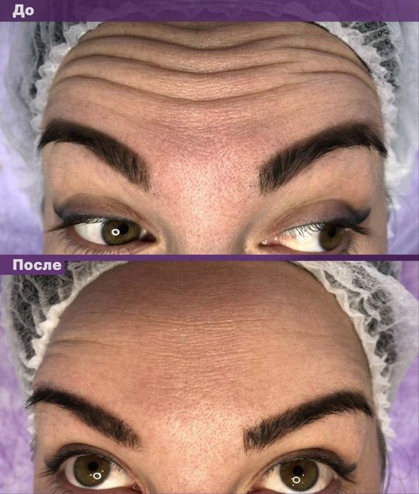 Ботокс Алматы АКЦИЯ