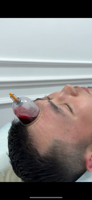 Хиджама 7000тг в подарок мануальная терапия