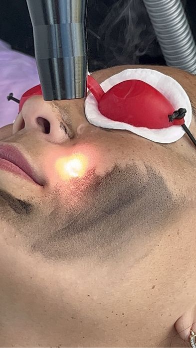 Лазерное удаление бровей