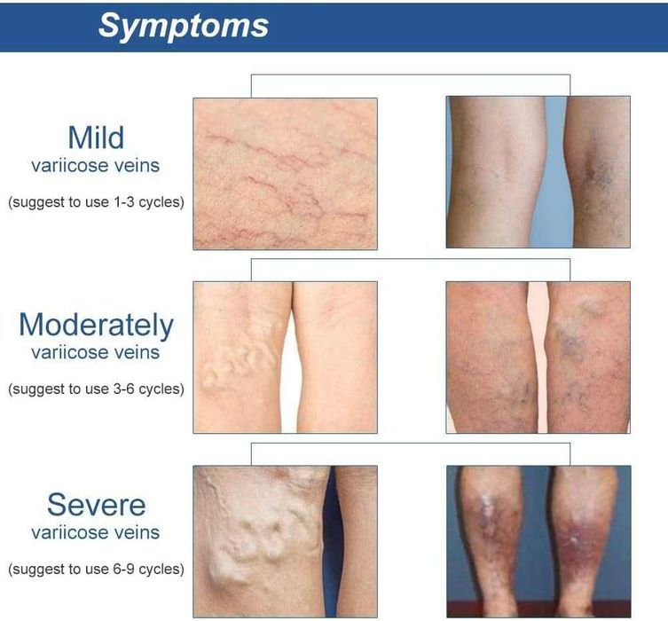 12броя Пластир за разширени вени, Лепенка за лечение на разширени вени