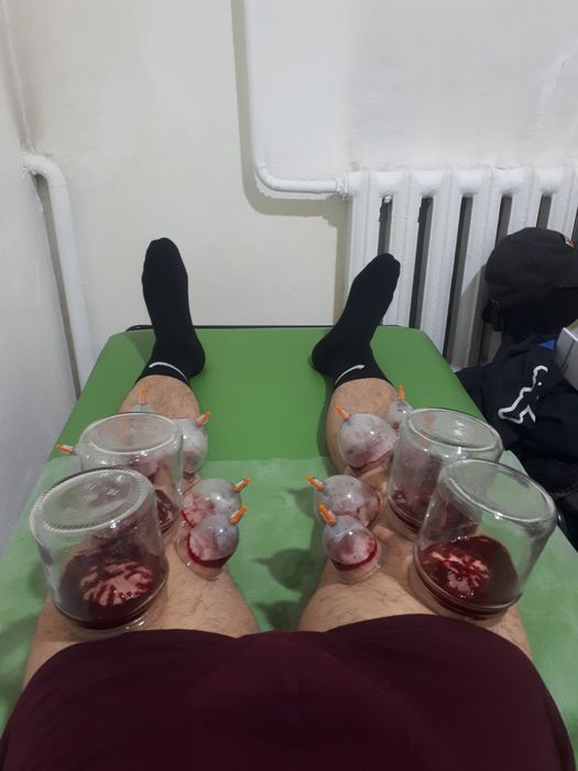 Хиджама и шертпе на выезд в городе Алматы