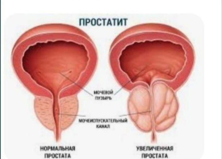ПрофессиОнальное лечение простатита.