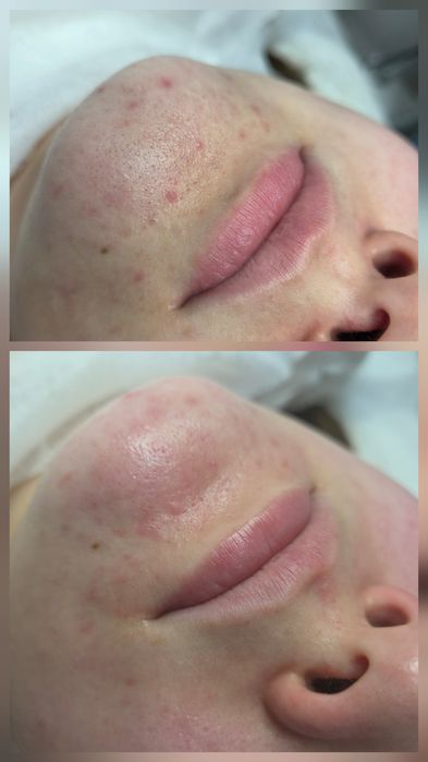 Косметолог.  Чистка лица