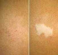 камуфляж пятен  витилиго