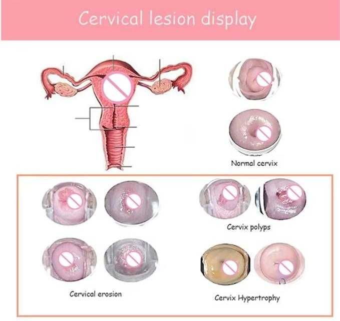 3D 360° Гинекологично Неинвазивна Лазерна Терапия Влагалищно Затягане Лазер Вагинално Стягане Вагинален Мускул Вагинално Подмладяване Стесняване