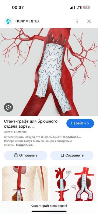 Srochna STENT-GRAFT 0.035  aorta tomirlariga yangi ochilmagan