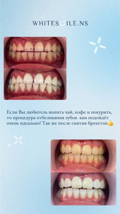 Отбеливание зубов. Готовый бизнес