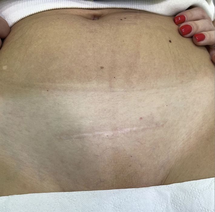 Epilare definitiva laser Bucuresti Sector 3 (zona trapezului)