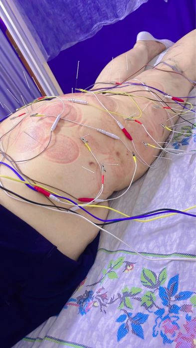 лечение Иглотерапией в Шымкентте