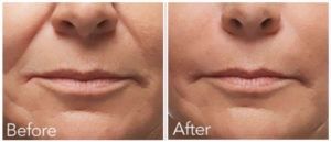 Супер акция 800тыс Носогубные складки