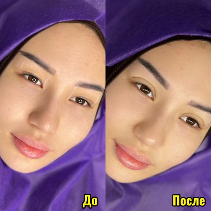 Нитевая блефаропластика