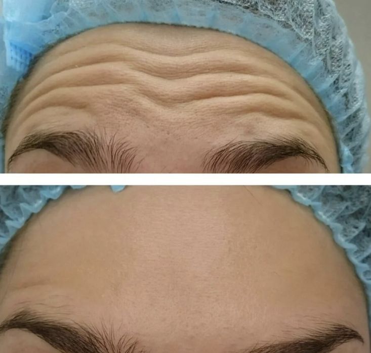 Ботокс мезаботокс фуллфейс