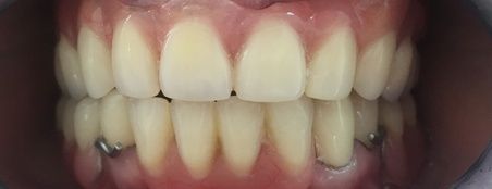 Зубные протезы микро протезы