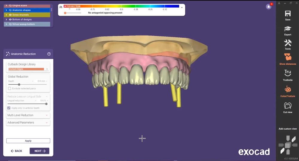 EXOCAD 3.3 Chemnitz + PartialCAD ​​3.3 + ExoPlan 3.1 + B4D iBar