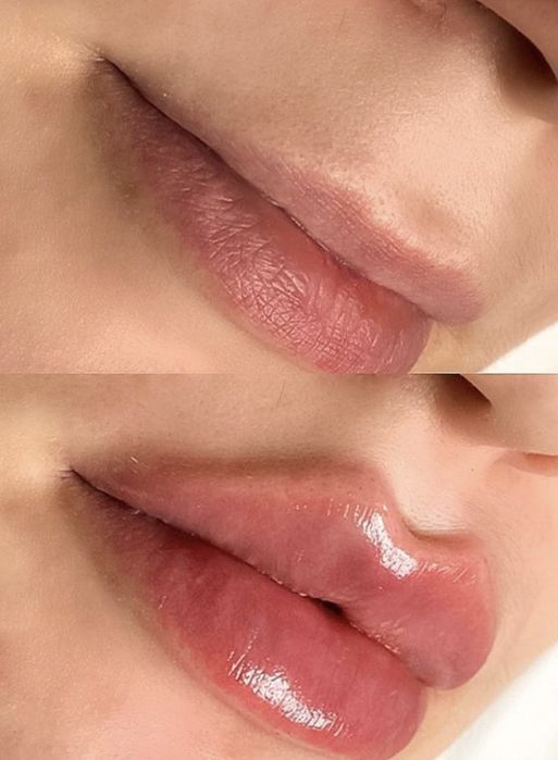 Ботокс и увелечение губ Срочно 50%скидкой места ограничены