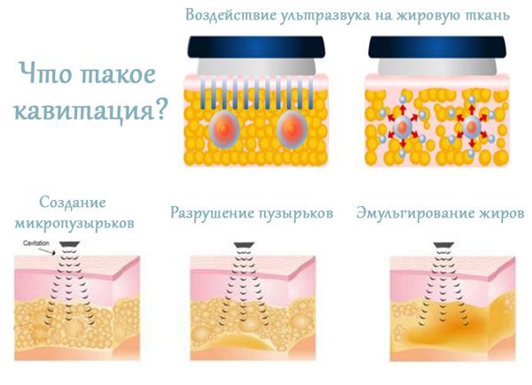 Кавитация лица до и после Ультразвуковая липосакция тела (Кавитация) - Красота / здоровье Ташкент на Olx