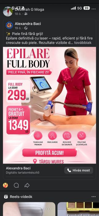 Epilare definitiva